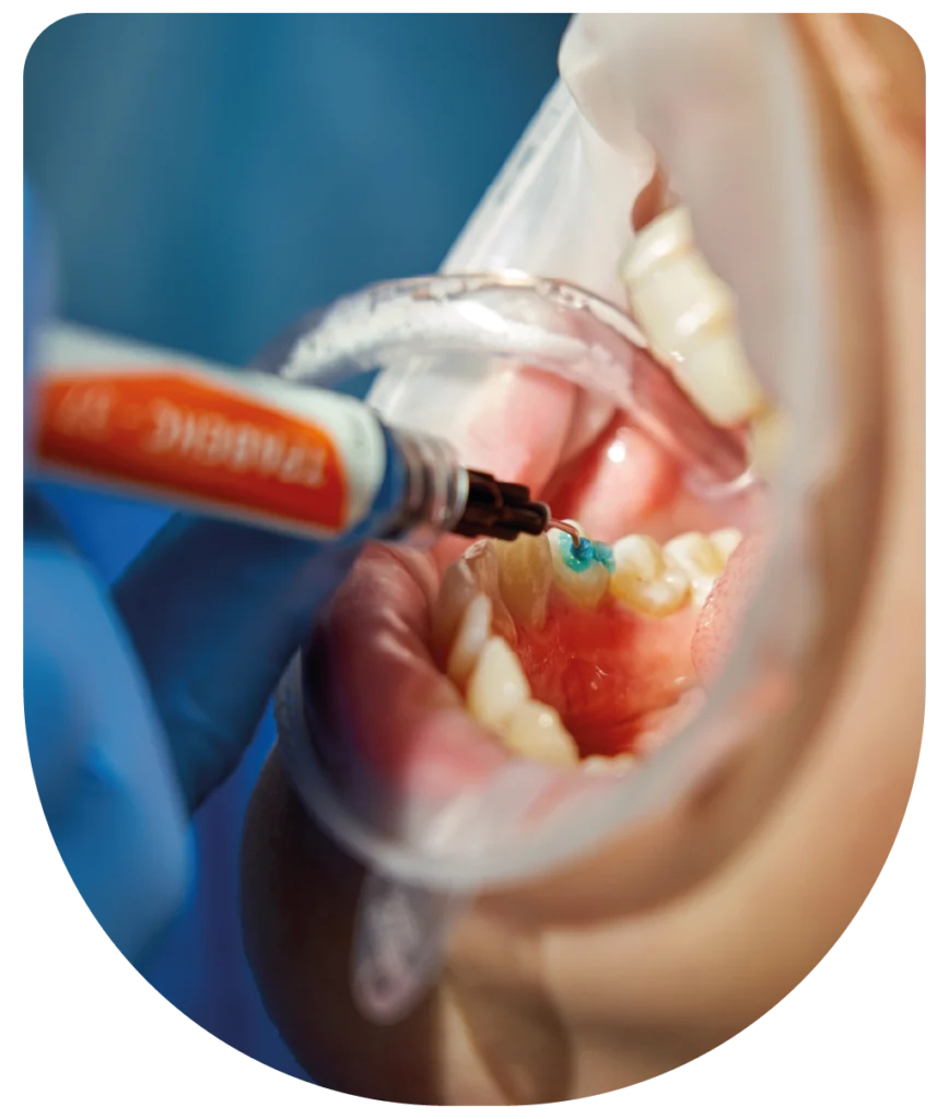 limpeza dentária profunda para gengivas