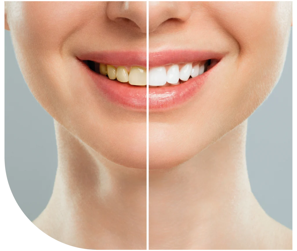 antes e depois de branqueamento dentário